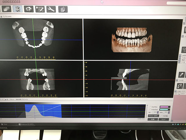 歯科用CT